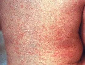 Una de las manifestaciones del virus africano son brotes en la piel.