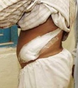 tráfico de órganos