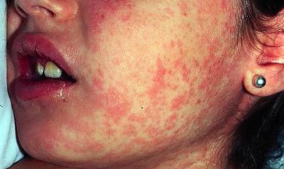 Brotes en la piel característicos del sarampión.